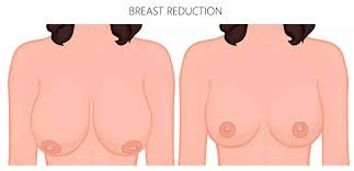 Breast Reduction