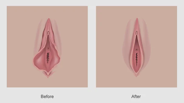 Vaginal Tightening